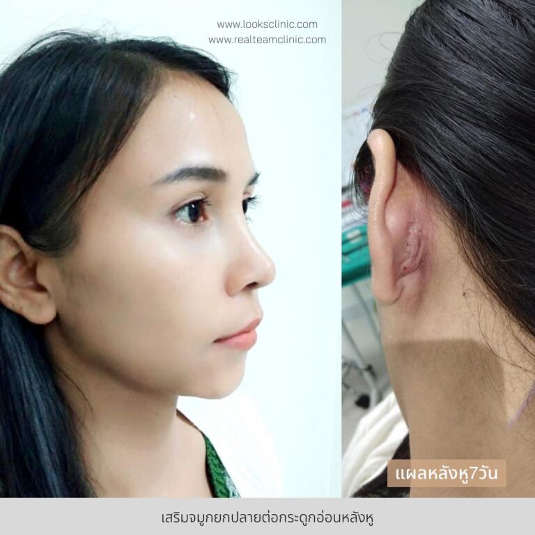 ศัลยกรรมจมูก เสริมจมูก